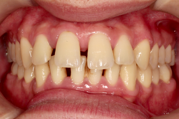 左右側上顎切歯、右側上顎側切歯の計3本に対するダイレクトボンディング