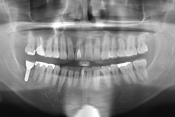 右側下顎第二大臼歯部にインプラント治療