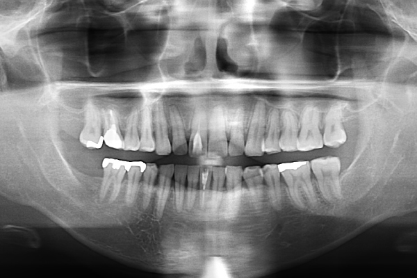 右側下顎第二大臼歯部にインプラント治療
