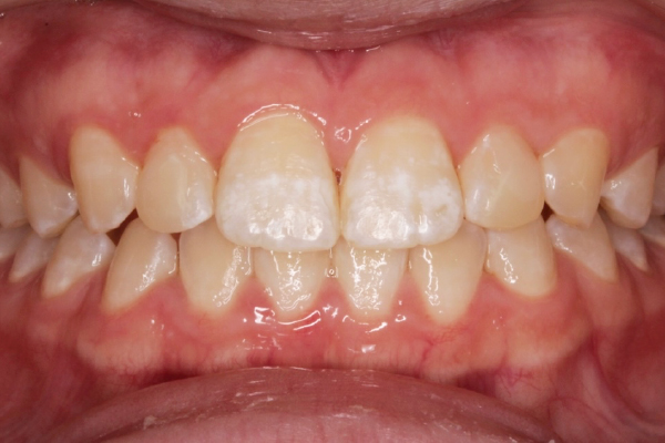 左右側上顎側切歯2本のダイレクトボンディング
