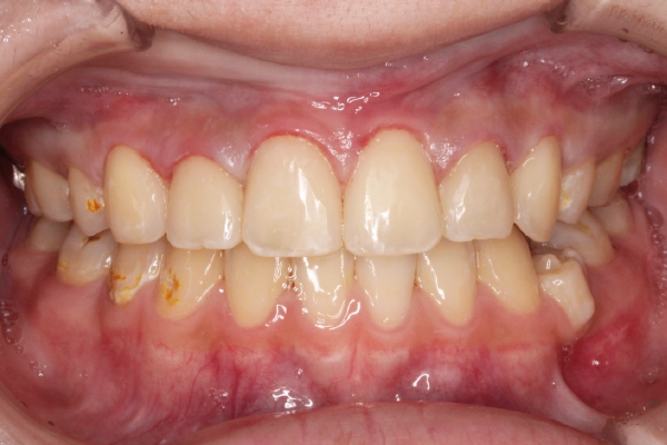左右側上顎犬歯～犬歯6本のダイレクトボンディング