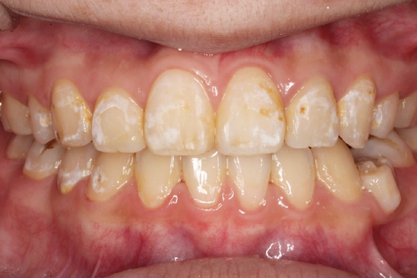 左右側上顎犬歯～犬歯6本のダイレクトボンディング