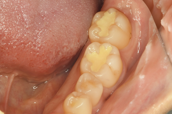 左側下顎第一、二大臼歯(2カ所)に対するダイレクトボンディング
