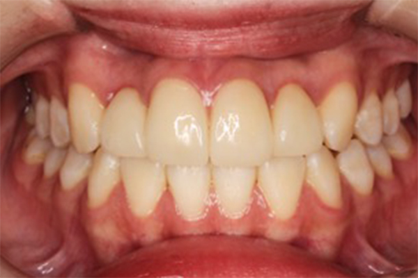 左右側上顎中切歯、左右側上顎側切歯の計4本のセラミック矯正