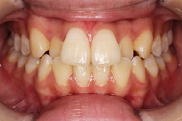 左右側上顎中切歯、左右側上顎側切歯の計4本のセラミック矯正