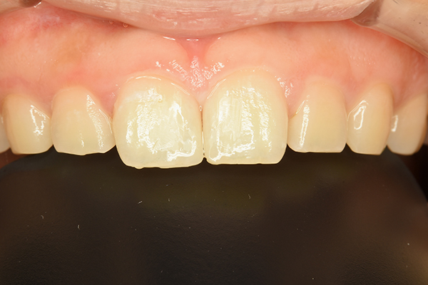 左右側上顎中切歯(2カ所)に対するダイレクトボンディング