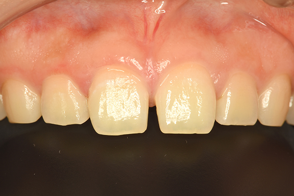 左右側上顎中切歯(2カ所)に対するダイレクトボンディング