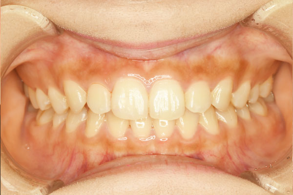 右側上顎中切歯切縁(1カ所)に対するダイレクトボンディング