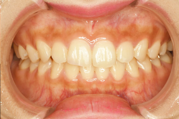 右側上顎中切歯切縁(1カ所)に対するダイレクトボンディング