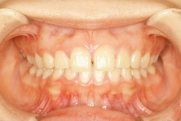 前歯2本(UR1,UL1)のダイレクトボンディング