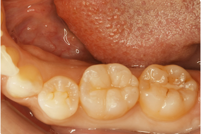 左側下顎第一大臼歯(1カ所)に対するダイレクトボンディング