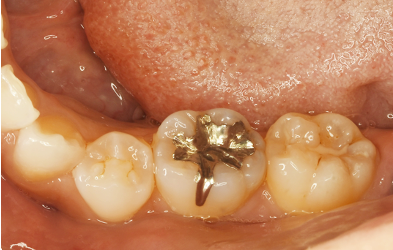左側下顎第一大臼歯(1カ所)に対するダイレクトボンディング