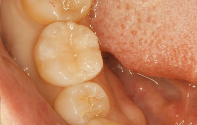 右側下顎第一大臼歯(1カ所)に対するダイレクトボンディング
