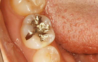 右側下顎第一大臼歯(1カ所)に対するダイレクトボンディング
