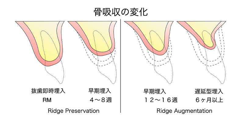 骨吸収の変化