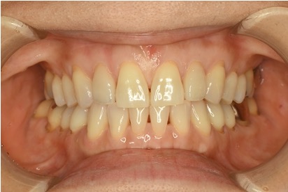 左右側上顎側切歯(2カ所)に対するラミネートべニア
