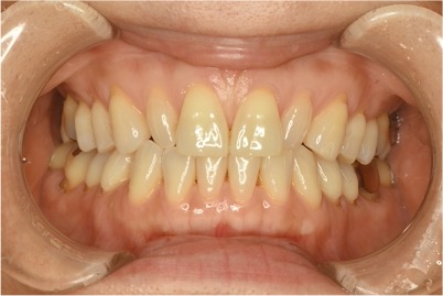 左右側上顎側切歯(2カ所)に対するラミネートべニア
