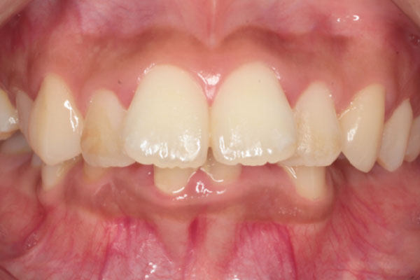 上顎左右側第一小臼歯、下顎右側中切歯の抜歯を行い裏側(舌側)矯正