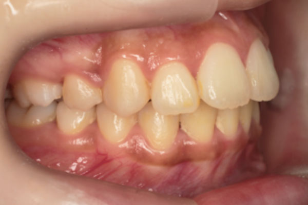上顎左右側第一小臼歯抜歯を行い裏側(舌側)矯正
