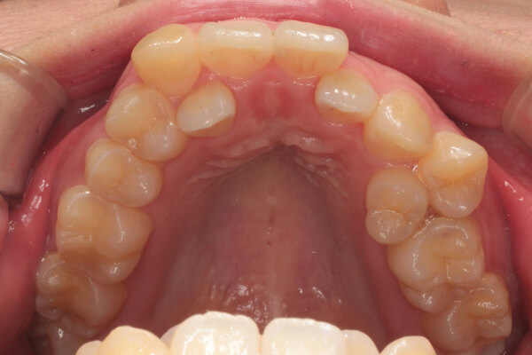 上顎左右側第一小臼歯抜歯を行いインプラントアンカーを併用しての裏側(舌側)矯正