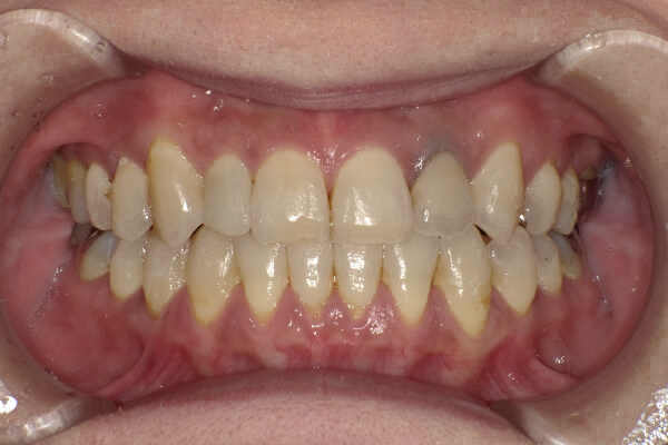 ディスキング、前歯の拡大を行いマウスピース矯正にて治療