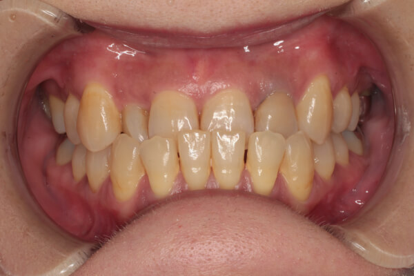 ディスキング、前歯の拡大を行いマウスピース矯正にて治療