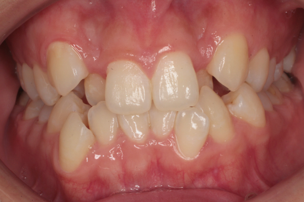 左右側上下顎第一小臼歯を計４本抜歯を行い裏側(舌側)矯正