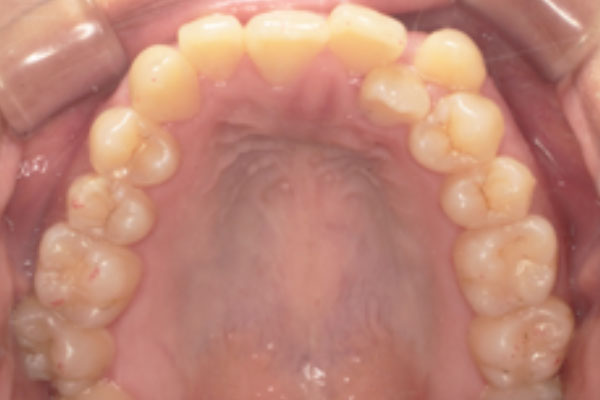 抜歯をせず拡大、ディスキングを行い裏側(舌側)矯正
