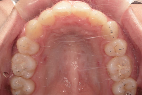上顎左右側第一小臼歯抜歯を行い裏側(舌側)矯正