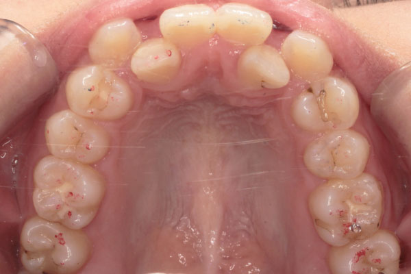 上顎左右側第一小臼歯抜歯を行い裏側(舌側)矯正