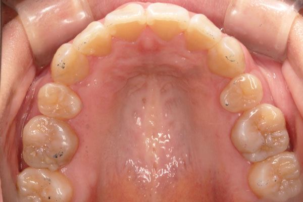 上顎左右側第一小臼歯抜歯を行いマウスピース矯正