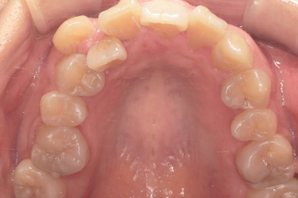 上顎左右側第一小臼歯抜歯を行いマウスピース矯正