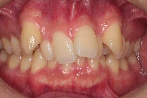 上下顎左右側第一小臼歯抜歯を行いマウスピース矯正
