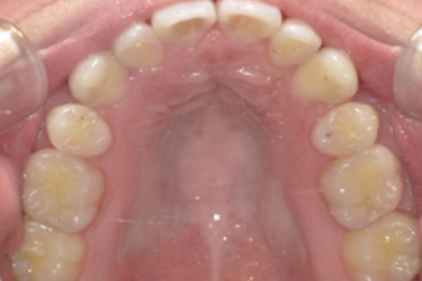 上顎左右側第一小臼歯抜歯を行いマウスピース矯正
