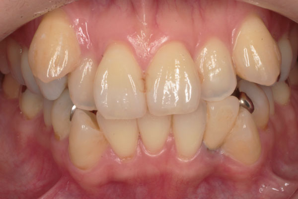 上下顎左右側第一小臼歯抜歯を行いマウスピース矯正
