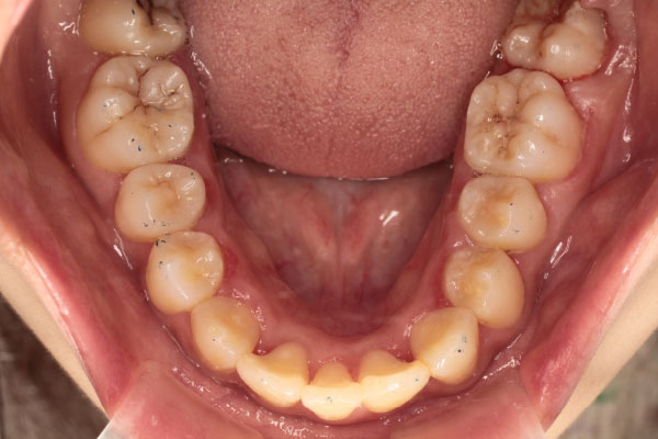下顎第一大臼歯