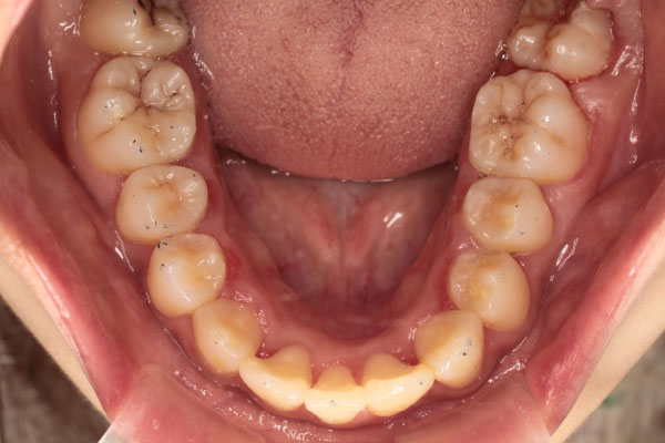 上顎左右側第一小臼歯、下顎右側中切歯の抜歯を行い裏側(舌側)矯正