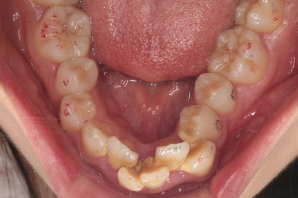 上顎左右側第一小臼歯、下顎右側中切歯の抜歯を行い裏側(舌側)矯正