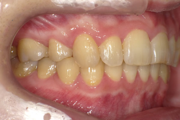 抜歯はせずディスキングを行い裏側(舌側)矯正