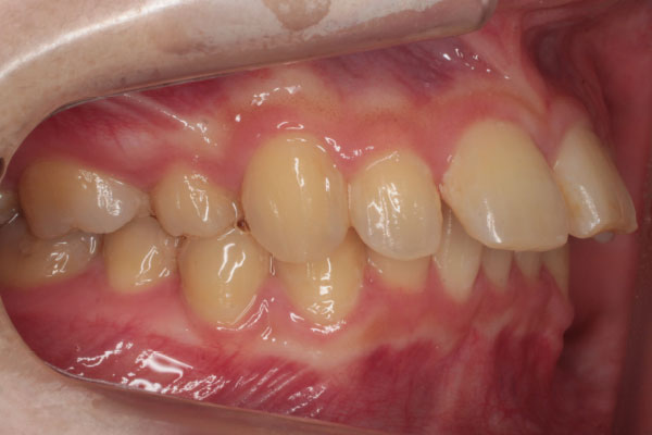 抜歯はせずディスキングを行い裏側(舌側)矯正