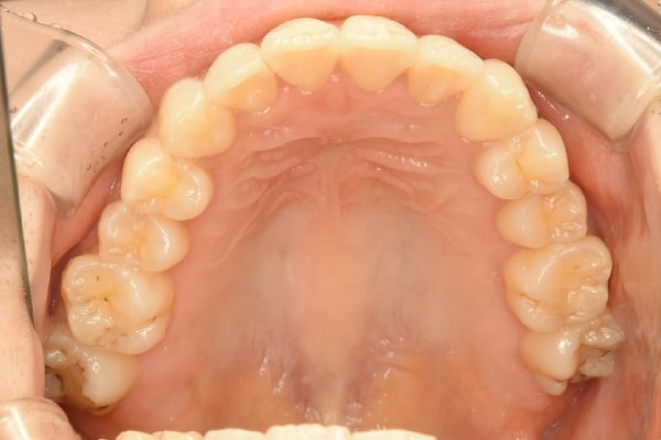 上顎左右側第2小臼歯まででディスキングを行いマウスピース矯正
