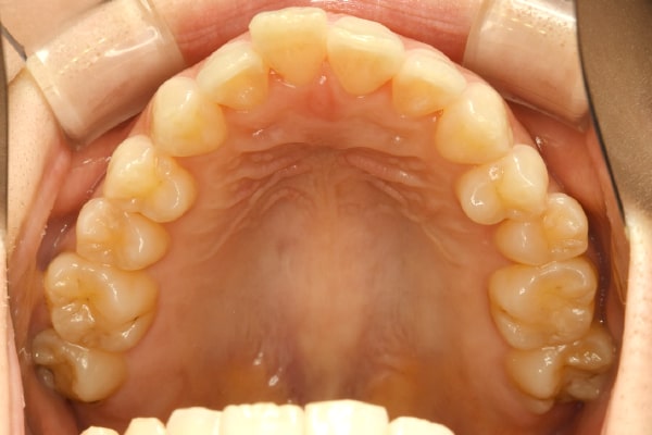 上顎左右側第2小臼歯まででディスキングを行いマウスピース矯正