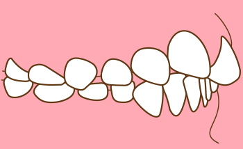 上顎前突(出っ歯)について