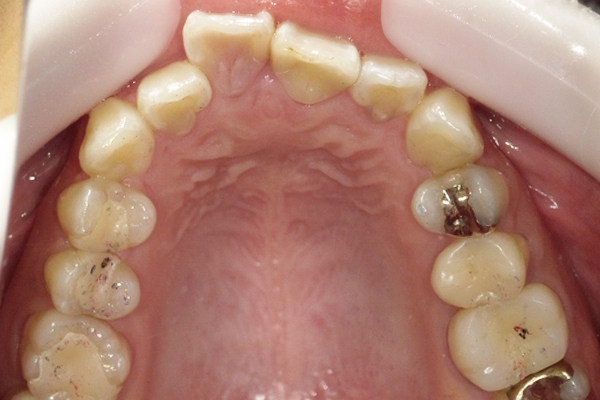 ディスキングを行いマウスピース矯正にて上顎前歯６本の部分矯正治療
