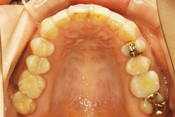 ディスキングを行いマウスピース矯正にて上顎前歯６本の部分矯正治療
