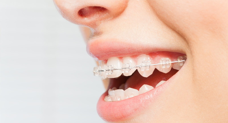 矯正歯科治療に年齢制限はある？