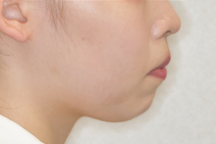 Eライン、横顔の改善症例１_治療前
