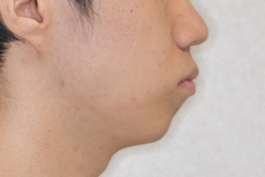 Eライン、横顔の改善症例2_治療前