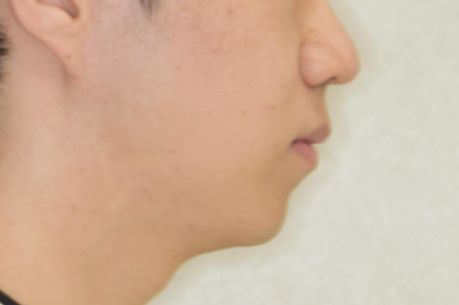 Eライン、横顔の改善症例2_治療後